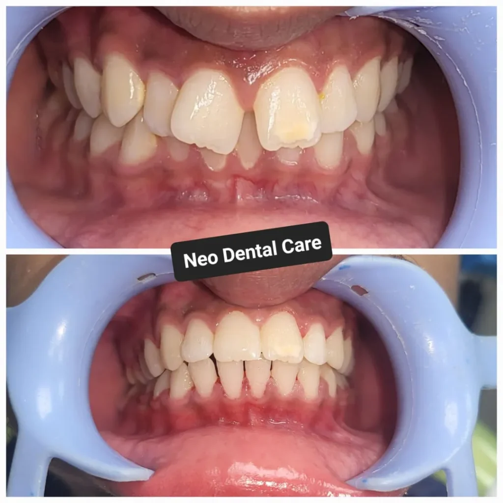 Before-and-after dental treatment: crowded, discolored upper teeth (top) and improved alignment with straighter teeth (bottom).