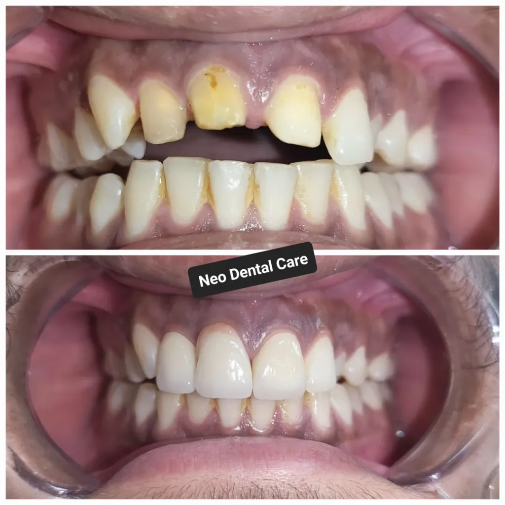 Two-panel collage showing a dental makeover: top image with decayed, yellowed front teeth; bottom image with a restored, white, straight smile after care.