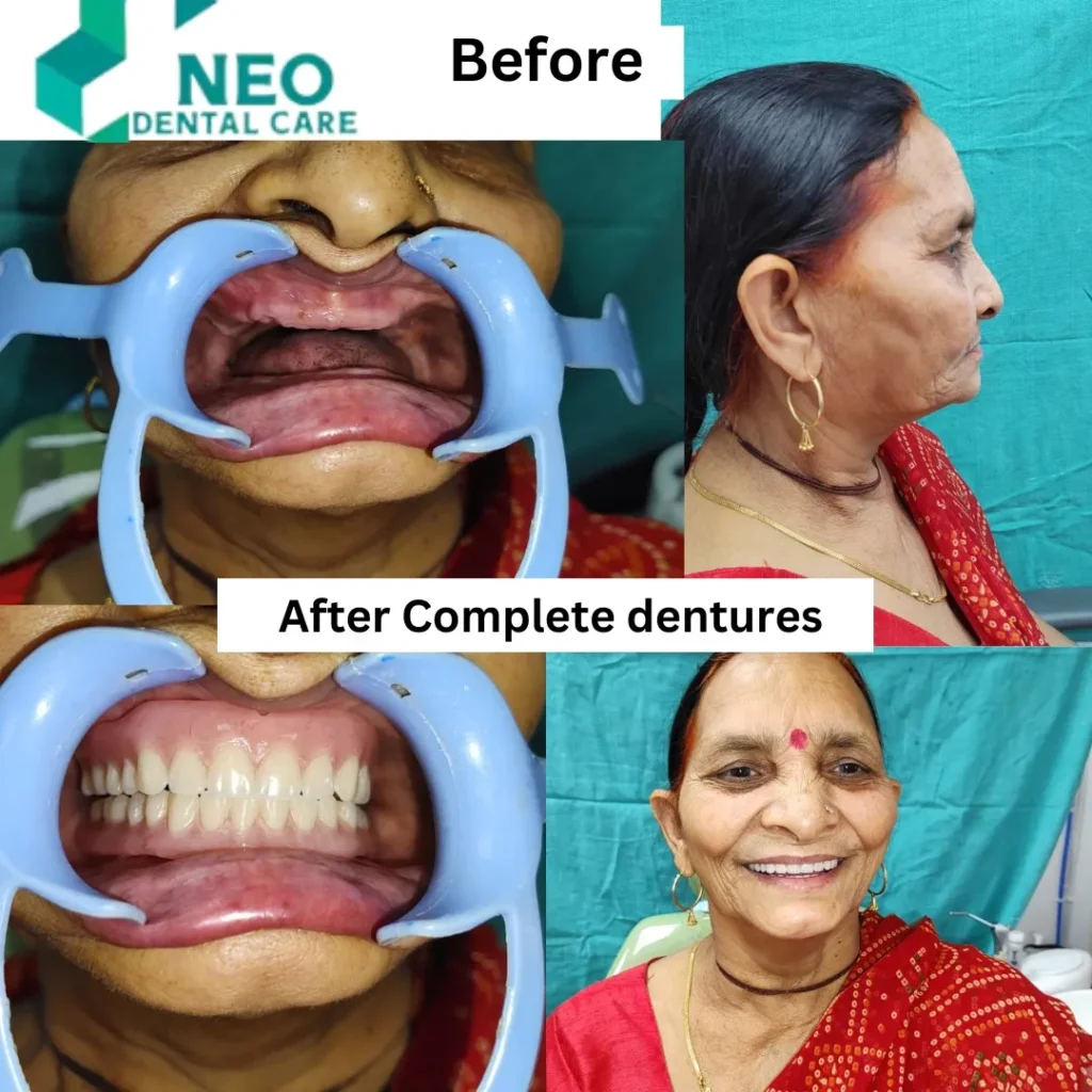 Collage showing before-and-after complete denture treatment: intraoral close-ups with retractors and profile and smiling portrait views of the patient.