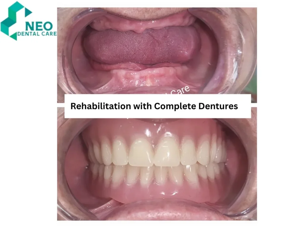 Before-and-after photo showing complete denture rehabilitation: top image with gum tissue and no teeth, bottom image with a full set of upper and lower dentures; left logo reads NEO DENTAL CARE.
