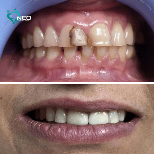 Two-panel before-and-after dental image: top shows a broken, discolored front tooth; bottom shows a restored, straight, white smile after treatment.
