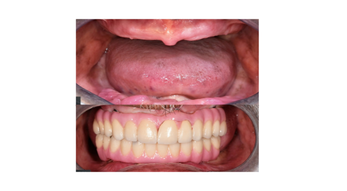 Two-panel close-up of a mouth: top shows bare gums and tongue, bottom shows a complete set of upper and lower dentures in place.