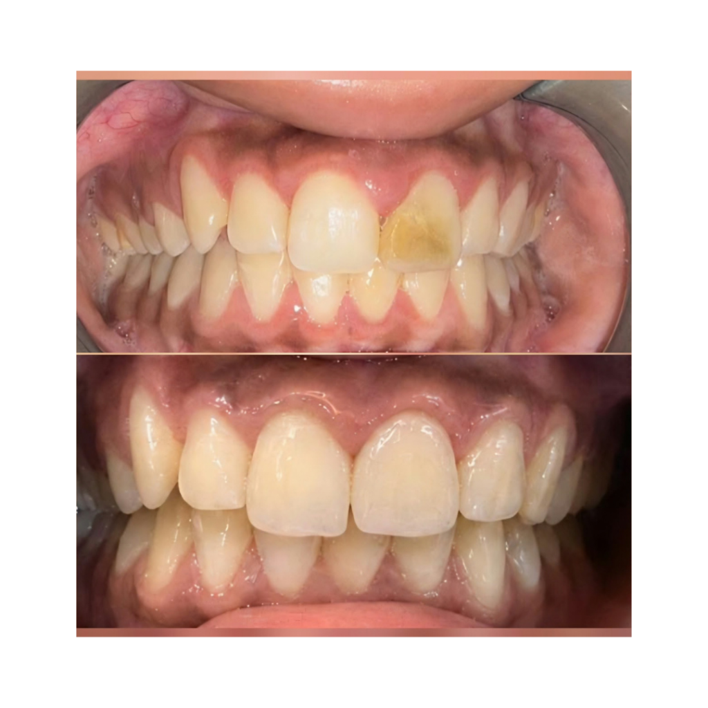 Before/after dental alignment and whitening: upper teeth show crowding and a yellow stain, after treatment teeth are aligned and whiter.