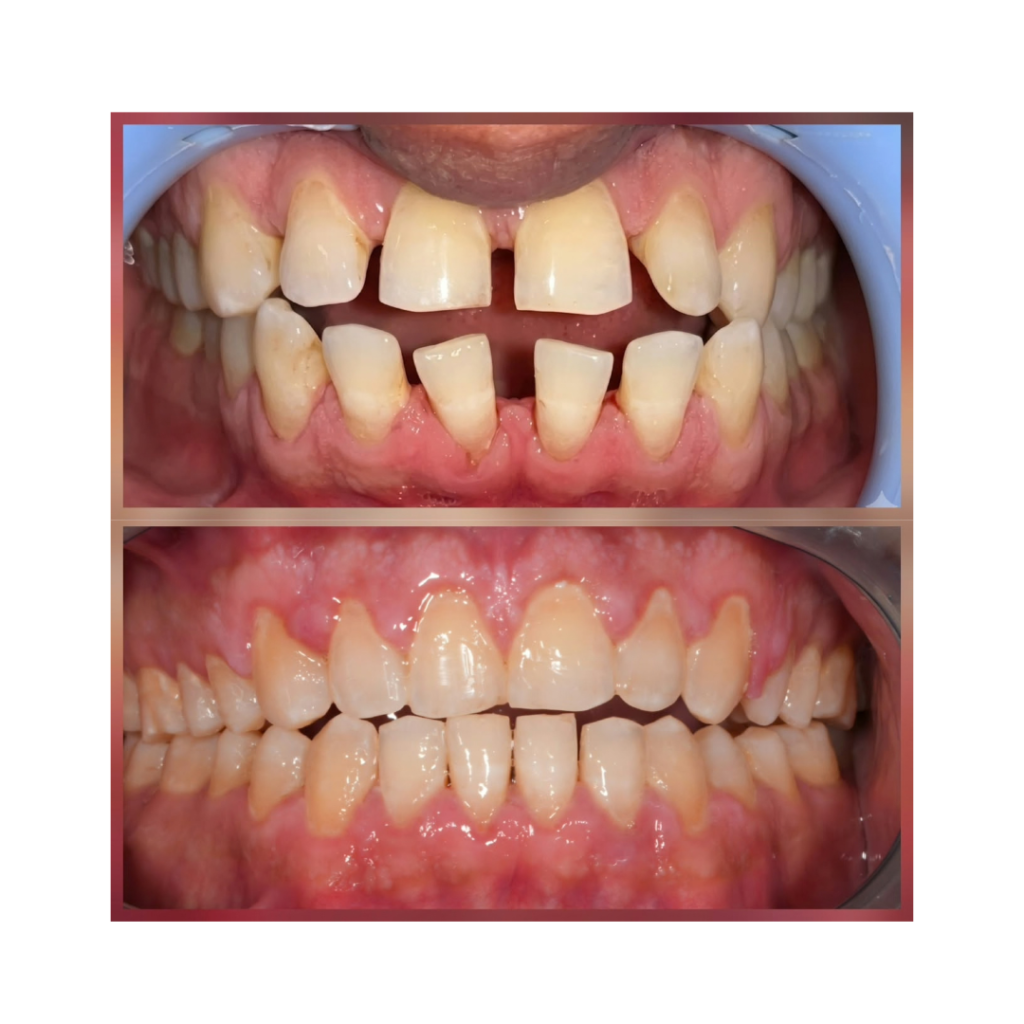 Front and center views of crowded, misaligned teeth with gaps in the upper arch and overlapping lower teeth; inflamed gums nearby.