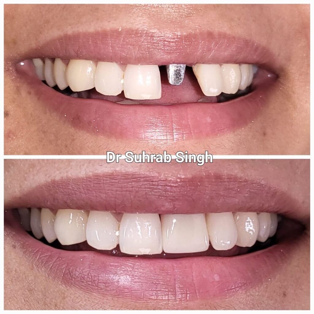 Smile makeover: top image shows a missing upper front tooth with a metal dental implant abutment; bottom image shows a closed gap and straight, white front teeth after treatment by Dr. Suhrab Singh.