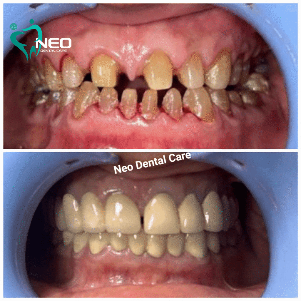Before-and-after dental transformation: severely worn, misaligned teeth with gaps and discoloration on top row, pink gums visible (clinic watermark Neo Dental Care). After treatment: straight, evenly aligned teeth with improved bite and whitening on bottom row.