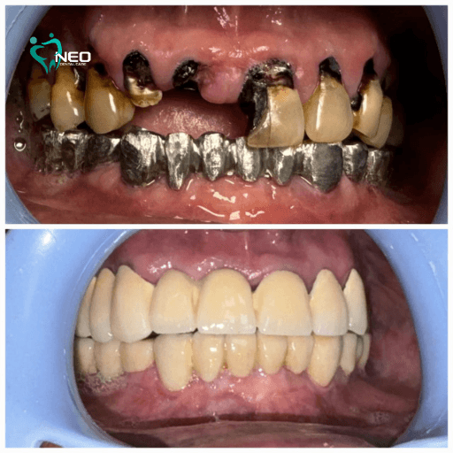 Two-panel dental before/after: top image shows severely decayed teeth with metal restorations; bottom image shows a full set of new, evenly aligned teeth (after treatment).