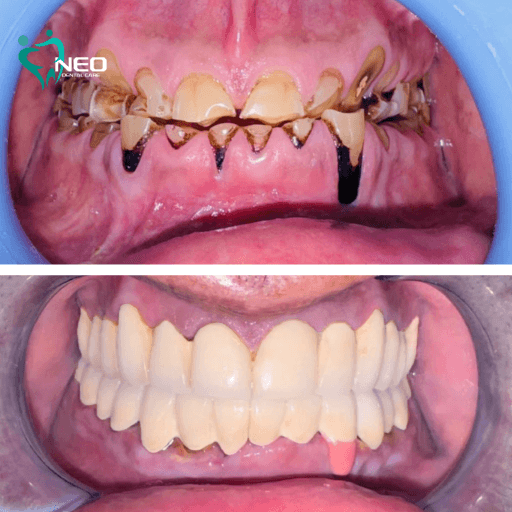 Comparison of teeth before and after dental restoration: top—severely decayed, broken teeth; bottom—a full set of white, evenly aligned teeth.