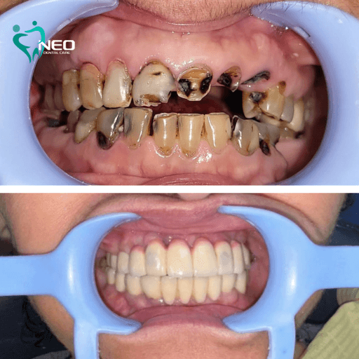 Two-panel dental transformation: top image shows severely decayed, deteriorating upper and lower teeth; bottom image shows a full set of healthy-looking teeth after restoration.