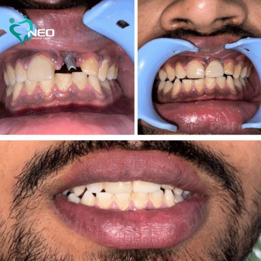 Collage of dental treatment progress: top left shows crowded, misaligned teeth with a missing front tooth; top right shows improved alignment with retractors; bottom shows a wide smile with straight teeth.