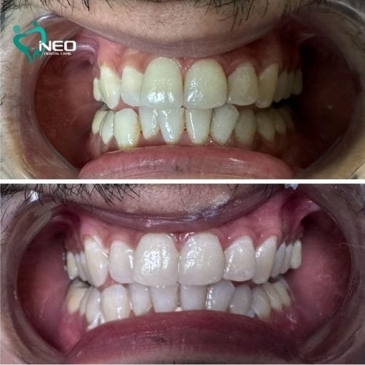 Two side-by-side photos comparing teeth before and after orthodontic treatment: top shows crowded, misaligned teeth; bottom shows straight, even bite and whiter appearance.