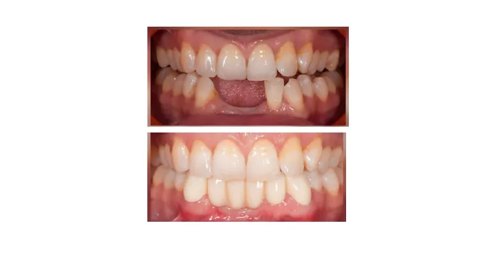 Before-and-after: top image shows crowded teeth, bottom image shows straightened teeth after orthodontic treatment.