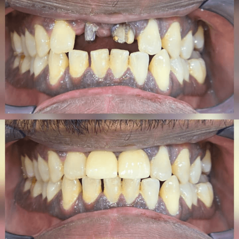 Before-and-after dental correction: top shows decayed, crowded teeth; bottom shows straight, whiter teeth after treatment.