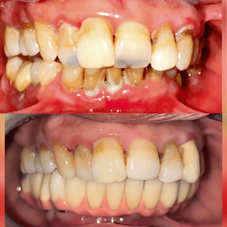 Two-panel dental transformation: top shows severely decayed, yellowed upper teeth with inflamed gums; bottom shows a full set of well-aligned teeth (likely dentures) and healthier gums.