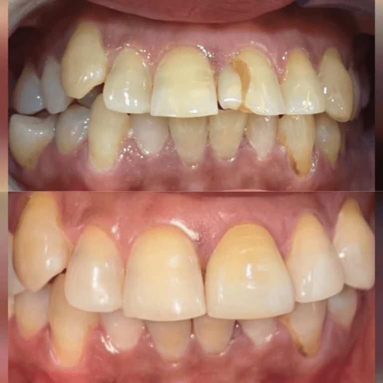 Before-and-after dental comparison: top image shows crowded, chipped upper teeth; bottom image shows straight, whiter front teeth after treatment.
