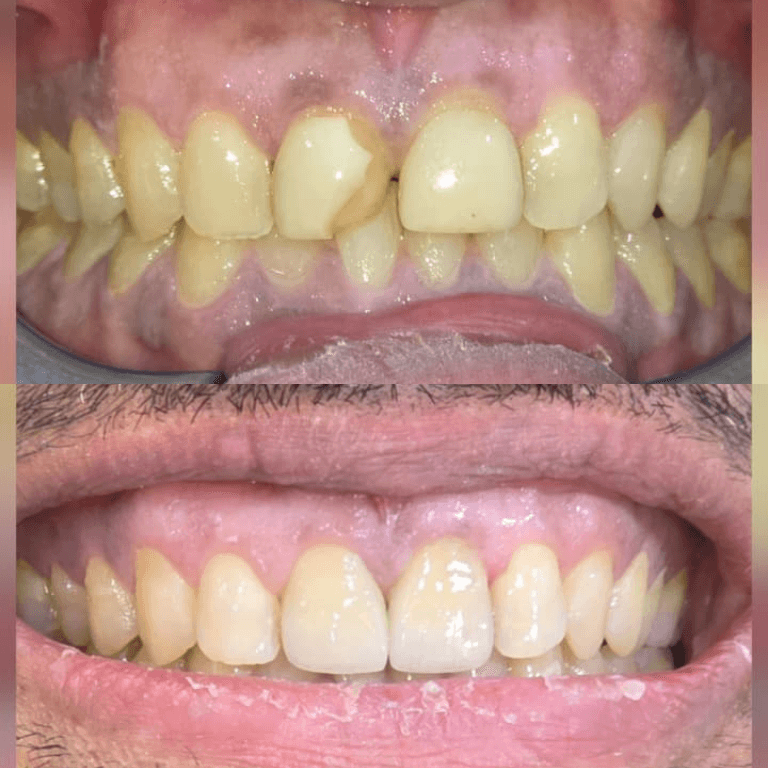 Close-up of a mouth showing a before-and-after dental transformation: yellow, misaligned top teeth and whiter, straight bottom teeth.