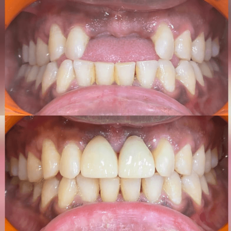 Front view of the upper and lower teeth showing crowding and misalignment, with overlapping lower incisors and uneven bite.