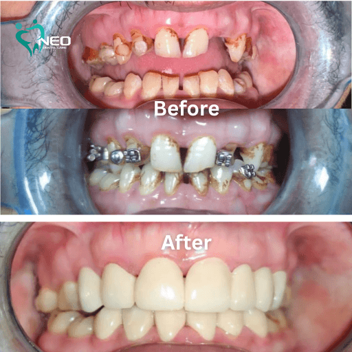 Three-panel collage showing dental transformation: before with decayed teeth, middle with braces, after with straight, white teeth.