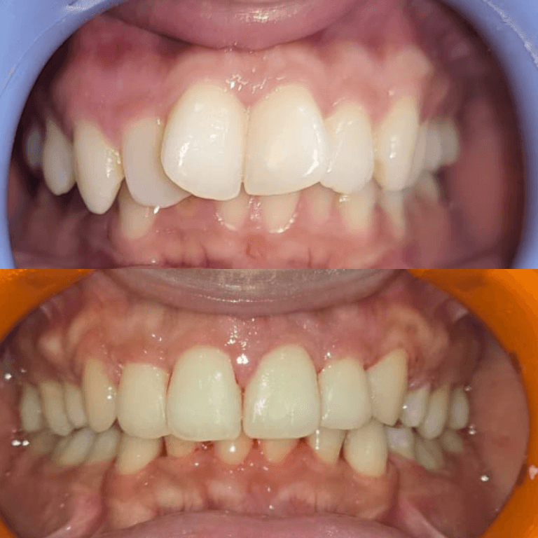 Close-up of a patient’s upper and lower teeth showing crowding and bite alignment issues in the front teeth.