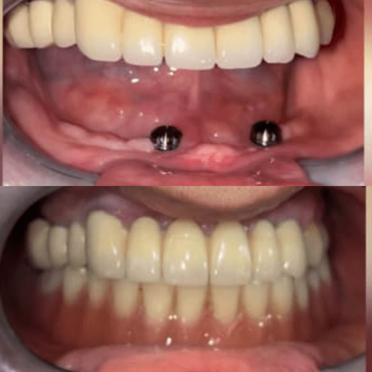 Two dental implants in the upper jaw with a full lower denture in place; mouth opened to show implant sites and surrounding gum tissue.