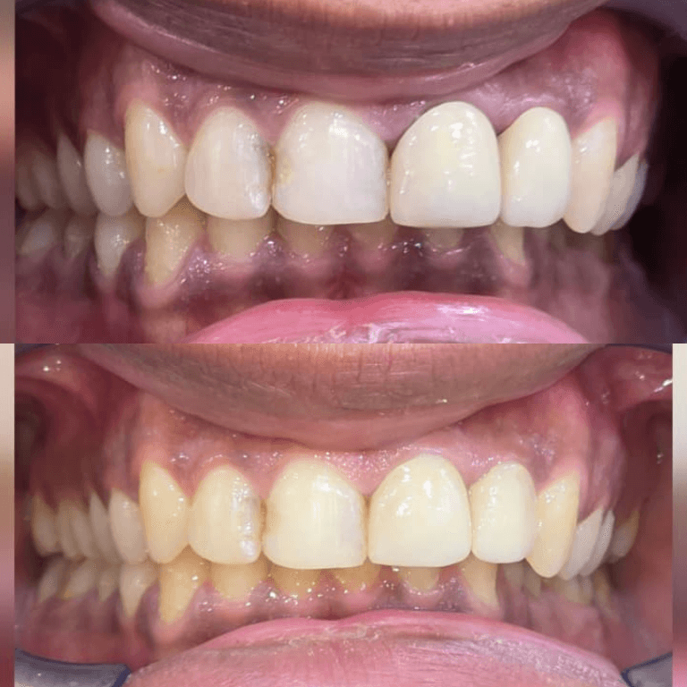 Close-up of upper and lower teeth; mild crowding and yellowish discoloration.