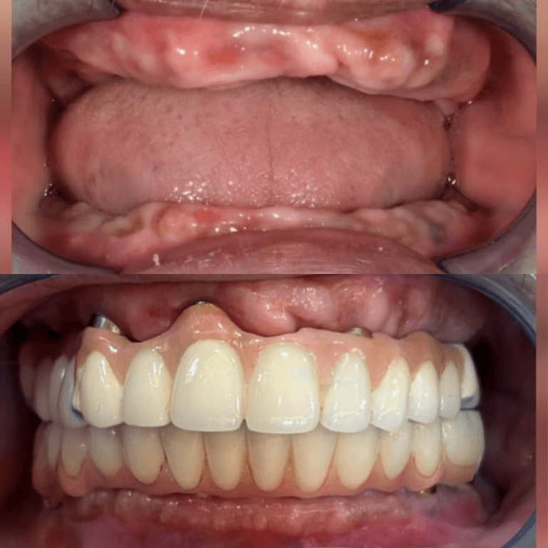 Close-up of a mouth showing a complete set of upper and lower dentures with pink gum tissue; dental implants or attachments are visible at the sides of the upper denture.