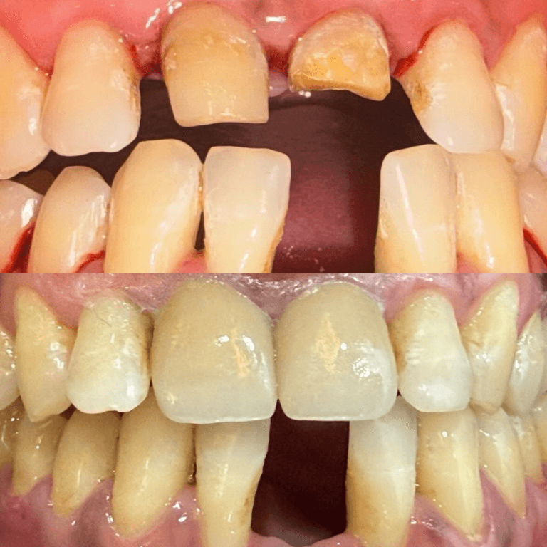 Close-up of the upper jaw showing a missing front tooth and chipped neighboring teeth.