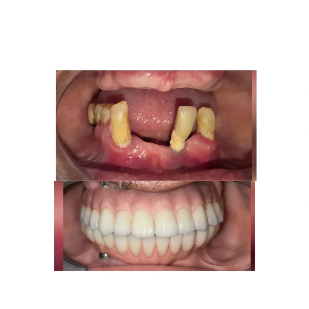 Before/after comparison of dental restoration: upper image shows several missing/yellowed teeth, inflamed gums; lower image shows a full set of white dentures in place.
