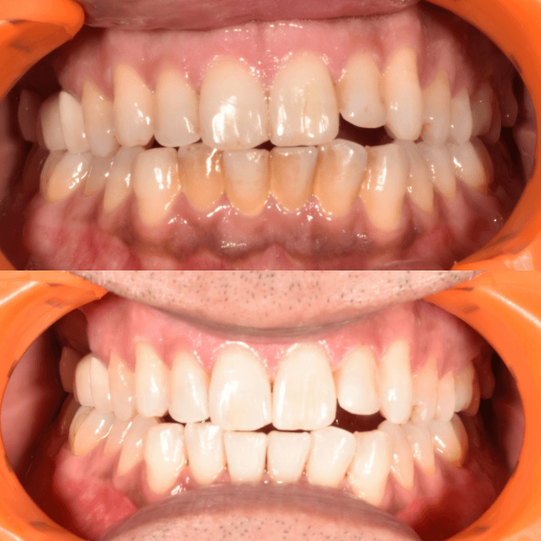Close-up of upper and lower teeth held apart with cheek retractors; mild crowding and yellow-brown staining on the lower front teeth.