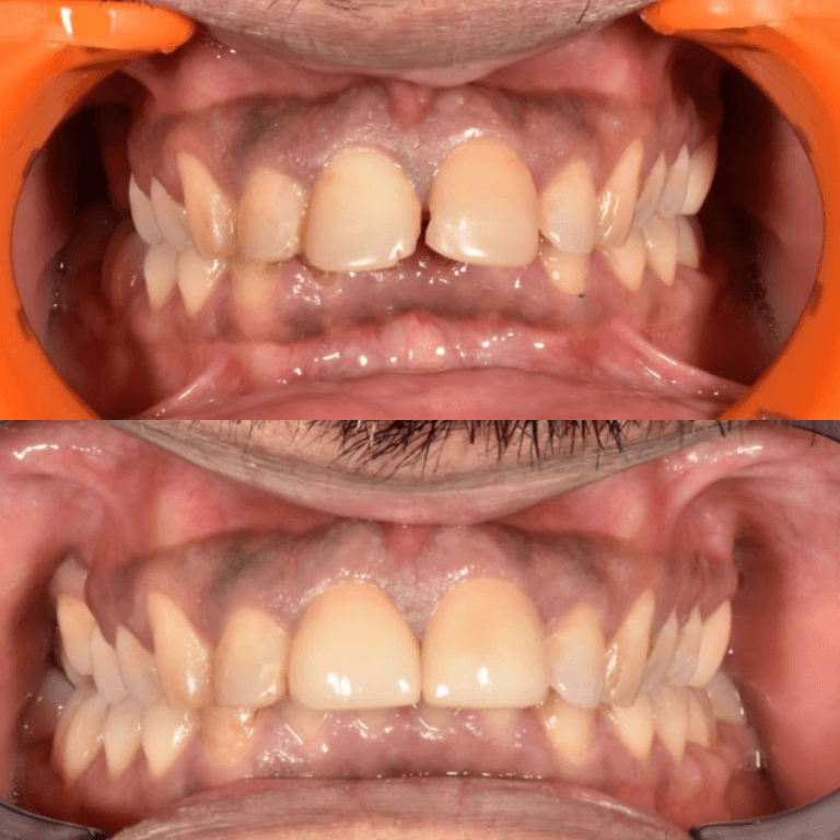 Close-up of an open mouth showing misaligned teeth with crowding; upper front teeth protrude and there is spacing between them, with visible gums.