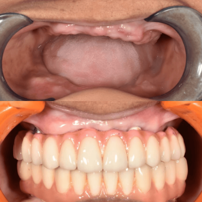 Full set of dentures (upper and lower) in an open mouth, with pink gum-colored bases and bright white artificial teeth, held open by cheek retractors.