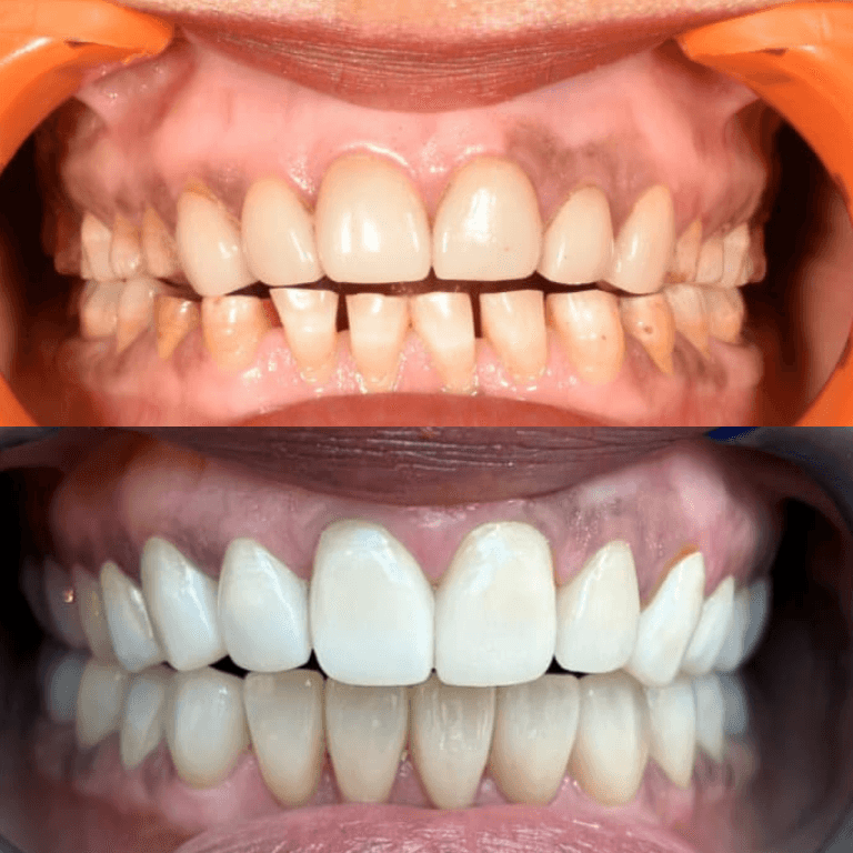 Close-up of a smile showing two sets of teeth: top row with gaps and uneven alignment, bottom row with straight, whitened teeth (before and after).