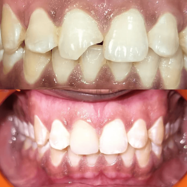 Before-and-after close-up of front teeth: top image shows crowding and an irregular bite; bottom image shows straighter, evenly spaced teeth after dental treatment.