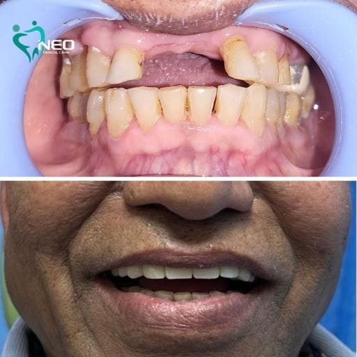 Before-and-after dental transformation: top image shows crowded, stained teeth; bottom image shows a healthy, straight smile.