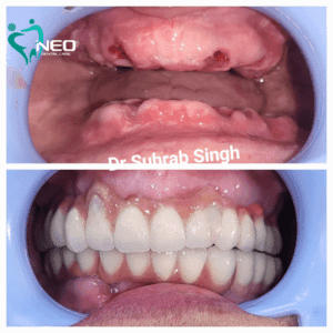 Before-and-after dental restoration: top image shows inflamed gum tissue with missing teeth, bottom image shows a full set of clean white dentures.