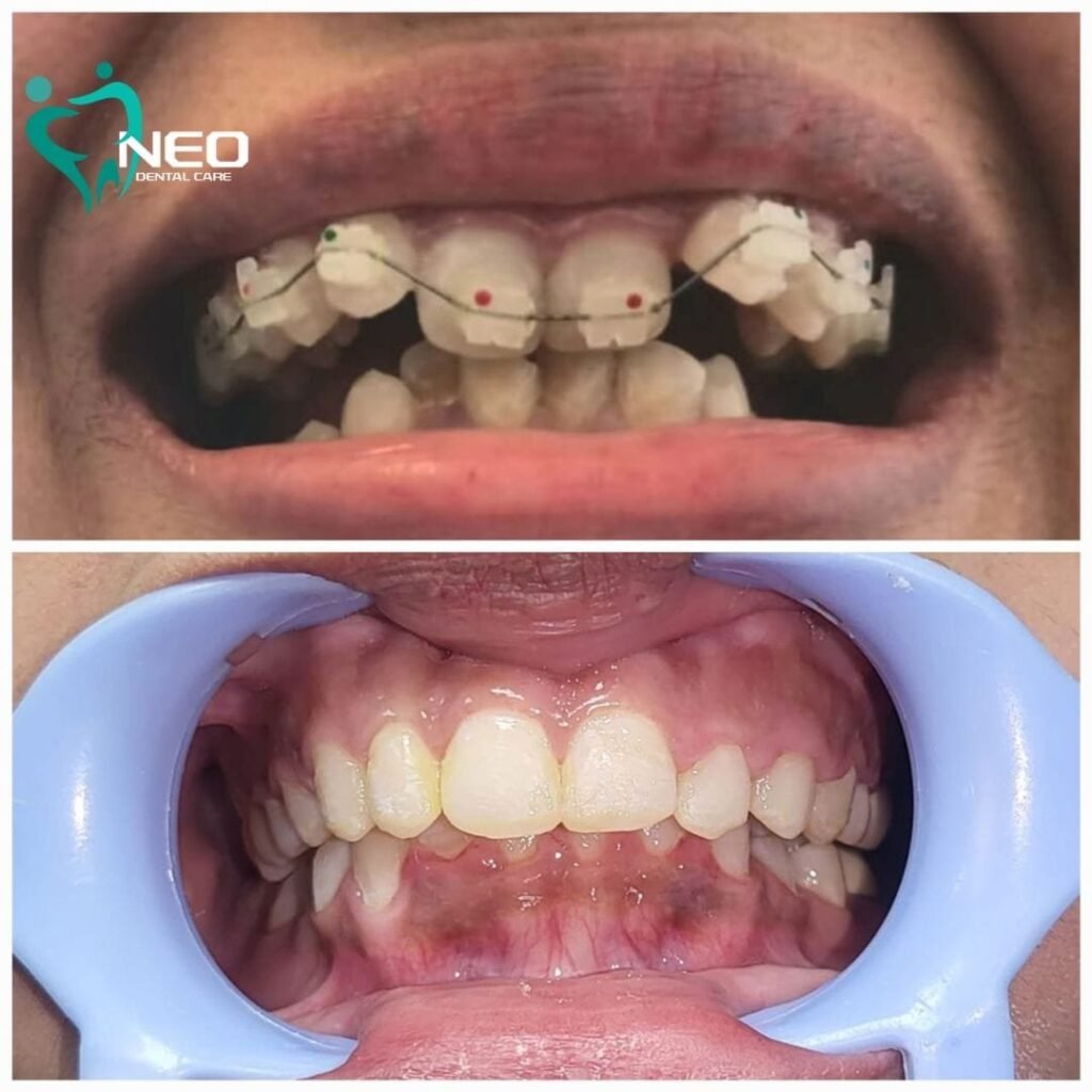 Before-and-after dental braces: top image shows upper teeth with brackets and wire, bottom image shows improved alignment with teeth straighter and bite corrected.