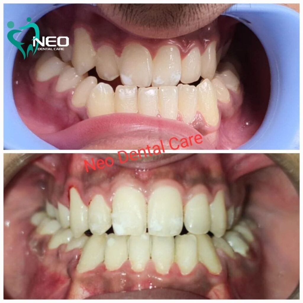 Two-panel photo showing orthodontic improvement: crowded upper teeth before (top) and straighter teeth after treatment at Neo Dental Care (bottom).
