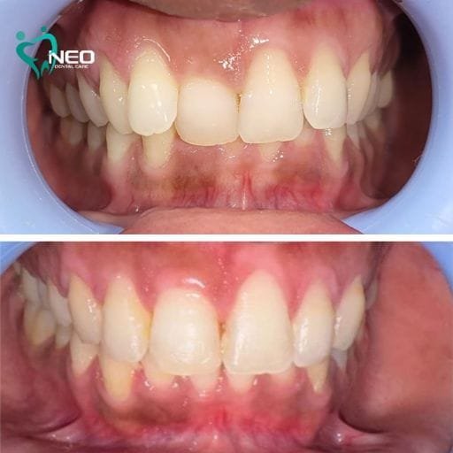 Close-up of both jaws showing dental alignment before and after treatment; top less aligned, bottom improved alignment with healthy gums.