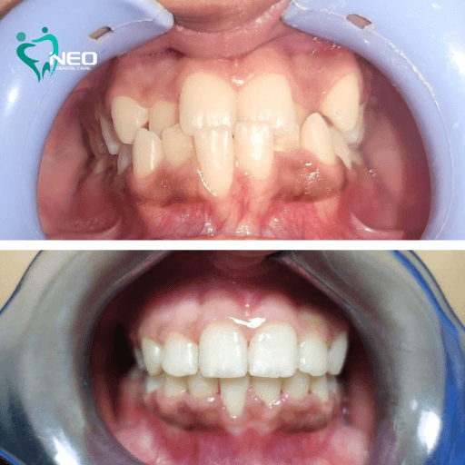 Before (top) and after (bottom) orthodontic treatment showing corrected alignment of upper and lower teeth.