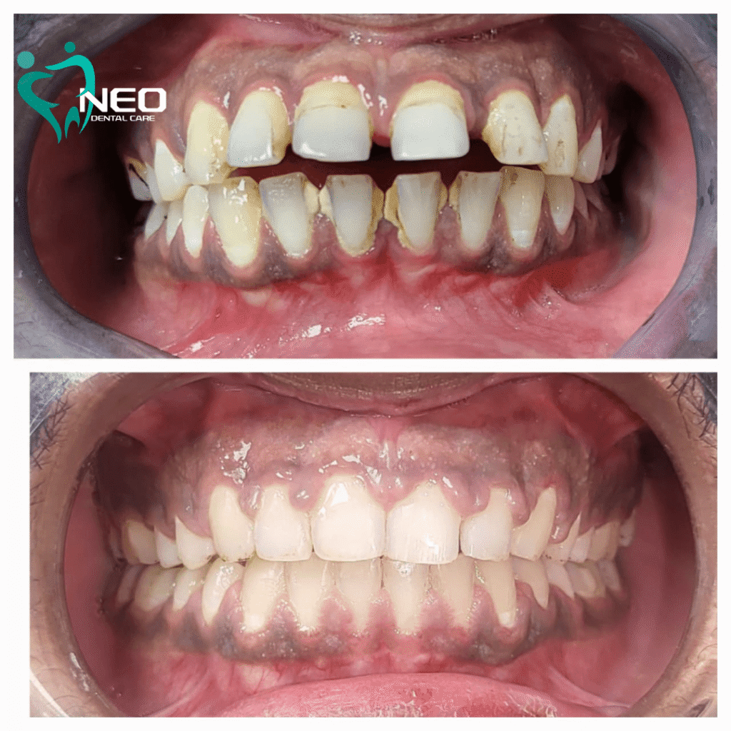 Two-panel dental transformation: top image shows crowded, stained teeth with gum inflammation; bottom image shows straightened, cleaner teeth with healthier gums (Neo Dental Care branding visible).