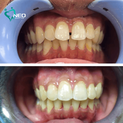 Before-and-after dental alignment: top image shows crowded, misaligned teeth (retracted lips), bottom image shows improved, straighter teeth after treatment, with a dental clinic logo in the corner.
