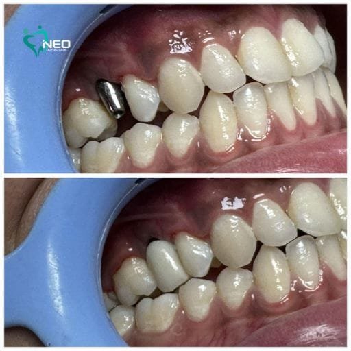 Two-panel photo showing teeth before and after orthodontic treatment: top image shows crowding and a dental implant; bottom image shows improved alignment and bite after treatment.