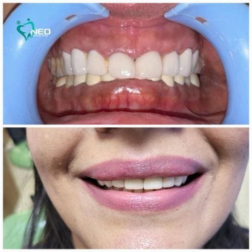 Two-panel dental image: top shows a mouth with a dental retractor and misaligned teeth; bottom shows a smiling patient with whiter, straighter teeth (after treatment).