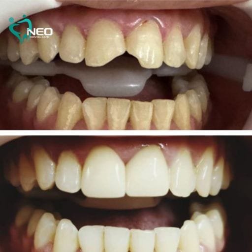 Before-and-after photos of a patient’s smile: top image shows yellow, crowded teeth; bottom image shows significantly whiter, straighter teeth after treatment.