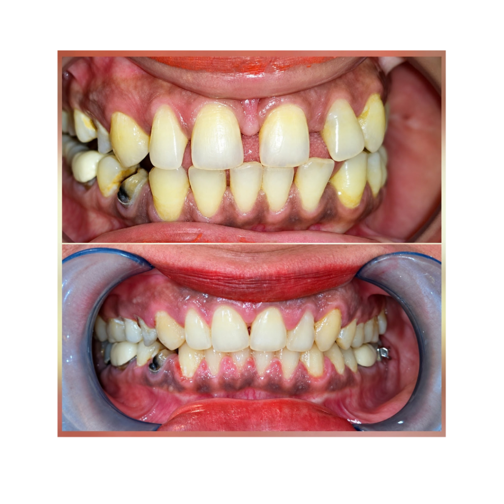 Two-row before-and-after dental photo: top shows severely crowded, yellowed teeth with misalignment; bottom shows improved alignment and healthier gums after treatment.