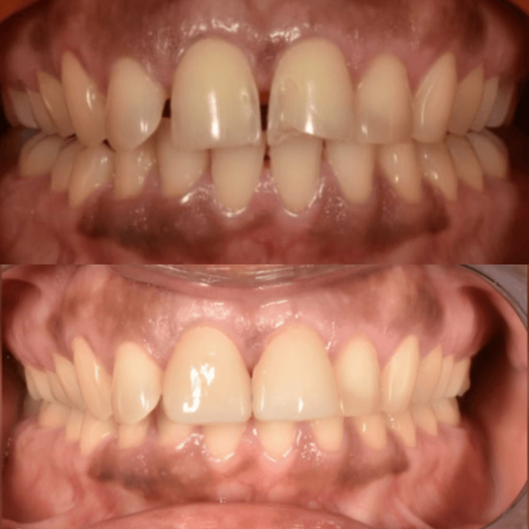 Close-up of a mouth showing crowded, misaligned upper and lower front teeth in both arches.