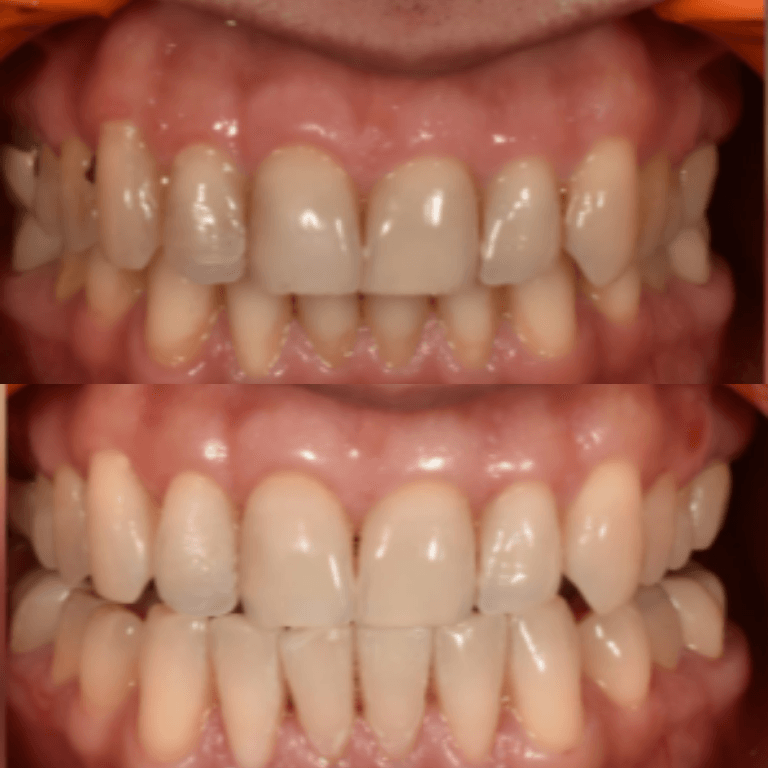 Close-up of upper and lower teeth showing crowding and misalignment in both arches, with pink gums visible.