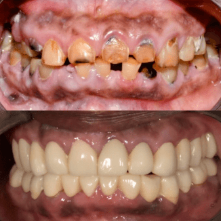 Close-up of a mouth showing severely decayed upper teeth and gums above a full set of white removable dentures on the lower jaw (before/after dental restoration).