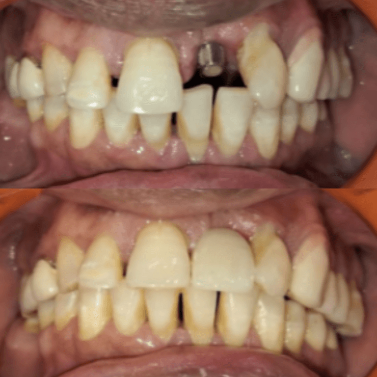 Close-up of a mouth showing severe dental crowding, worn and discolored teeth, and a missing upper tooth.