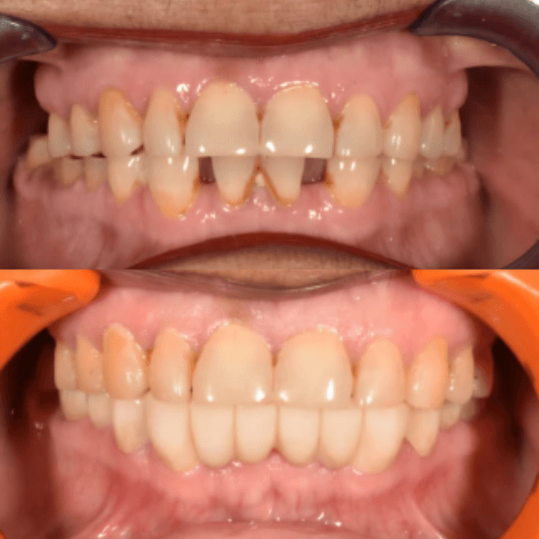 Close-up of an open mouth showing misaligned, crowded upper and lower teeth with a gap between the upper central incisors.